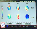 fibromyalgia_feedback