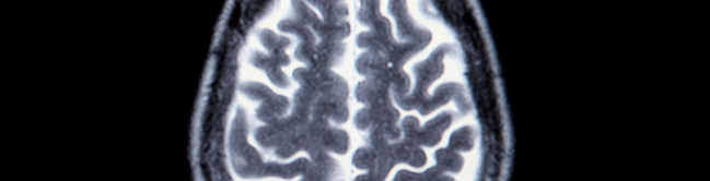 head_injury_neurofeedback